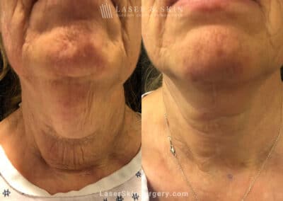 Cervicoplasty to Treat Loose Neck Skin