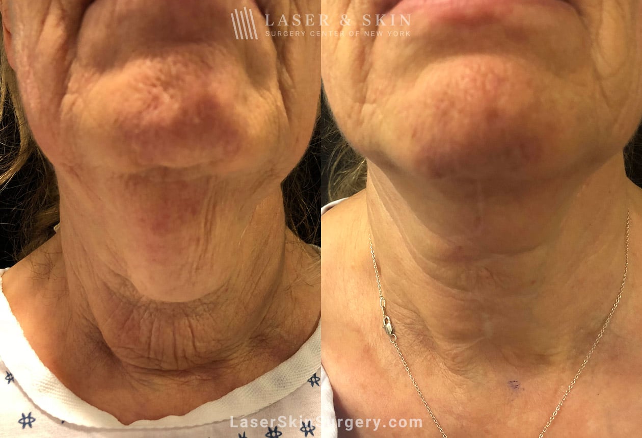 Cervicoplasty-for-loose-neck-skin-Hoffman-New-York-City-1 neck lift results