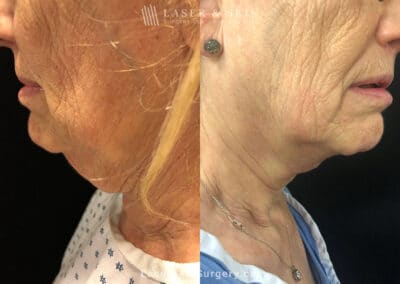 Cervicoplasty to Treat Loose Neck Skin