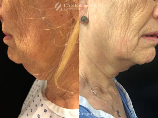 Cervicoplasty to Treat Loose Neck Skin