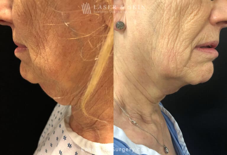 Cervicoplasty to Treat Loose Neck Skin