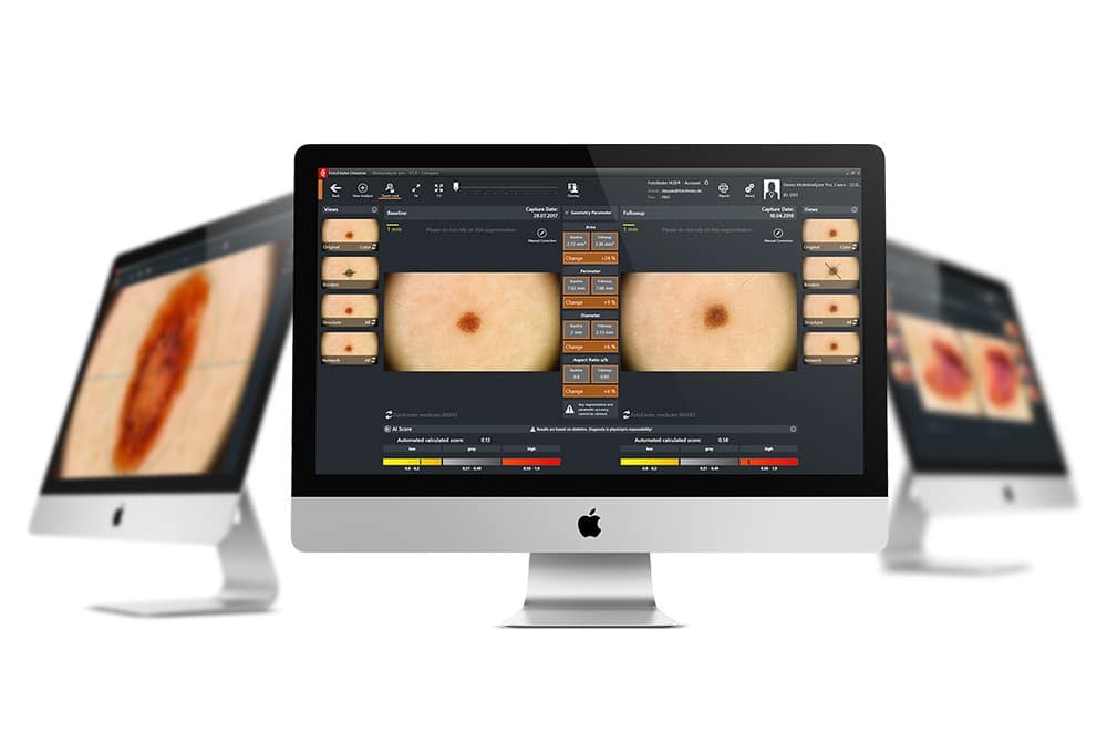 FotoFinder_Moleanalyzer_skin-cancer-screening-NYC