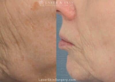 Fraxel Laser to reduce the appearance of wrinkles around the nose and mouth