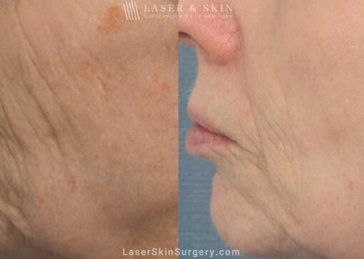 Fraxel Laser to reduce the appearance of wrinkles around the nose and mouth