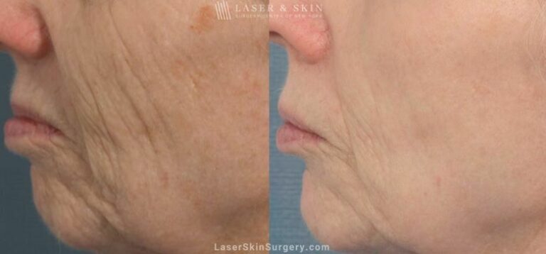 Fraxel Laser to reduce the appearance of wrinkles around the nose and mouth