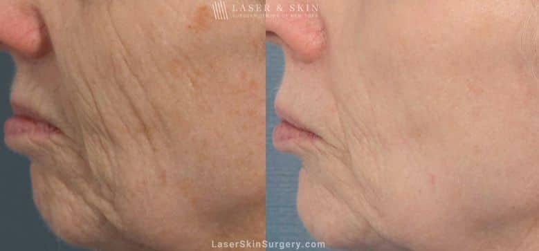 fraxel laser for facial wrinkles before and after