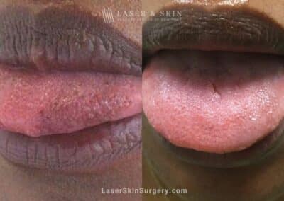 Ruby Laser to Treat Discoloration on Tongue