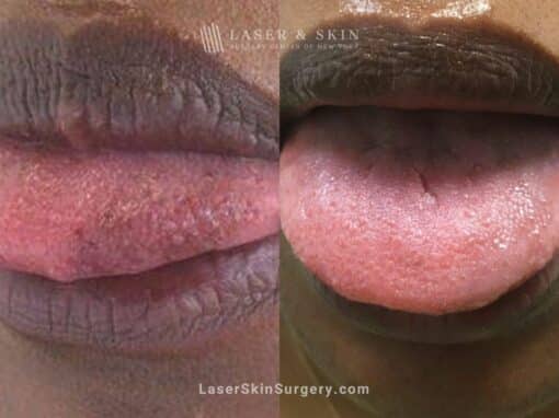 Ruby Laser to Treat Discoloration on Tongue