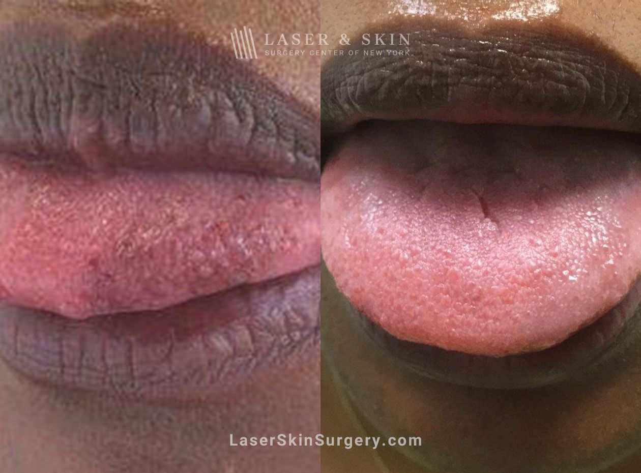 Laser-to-address-fissures-discoloration-on-tongue-New-York-City-1 laser acne scar treatment in new york, ny