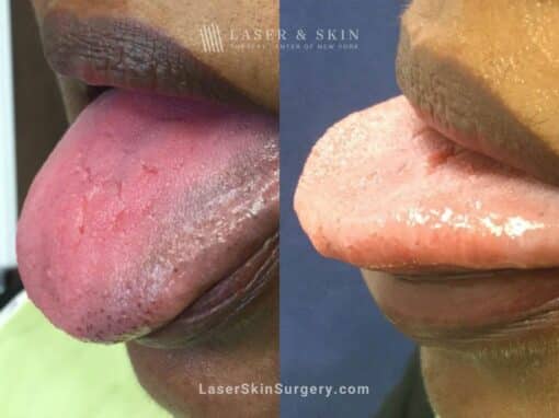 Ruby Laser to Treat Discoloration on Tongue