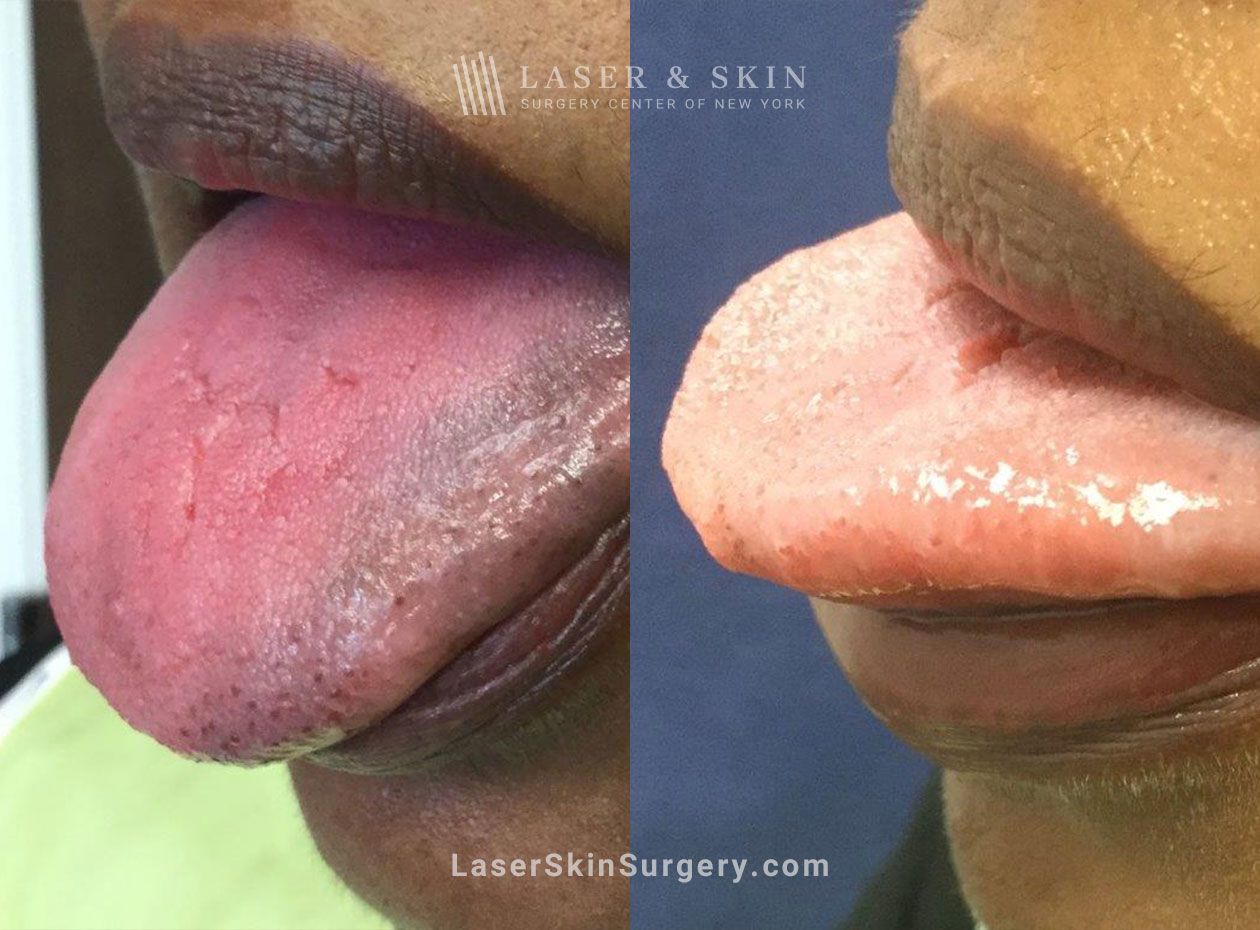 Laser-to-address-fissures-discoloration-on-tongue-New-York-City laser acne treatment in new york