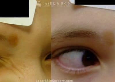 Laser Treatment for Birthmark