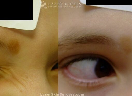 Laser Treatment for Birthmark