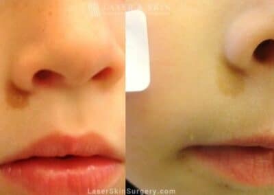 Laser Treatment for Café au Lait Pigmented Birthmark