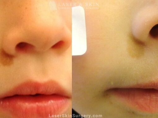 Laser Treatment for Café au Lait Pigmented Birthmark