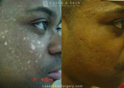 Laser Treatment for Hypopigmentation