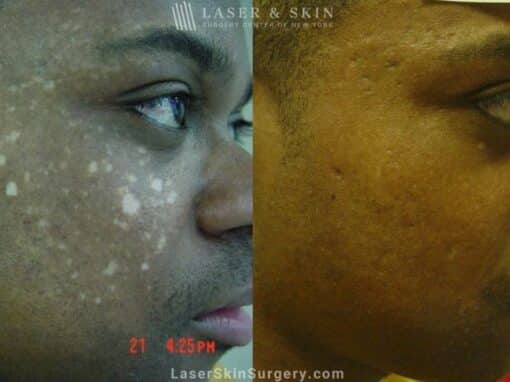 Laser Treatment for Hypopigmentation