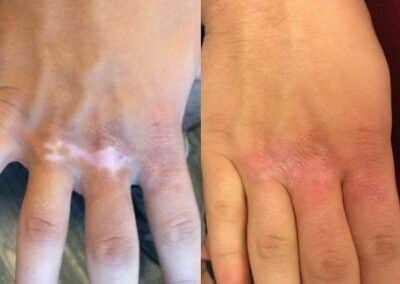 Laser Treatment for Hypopigmentation