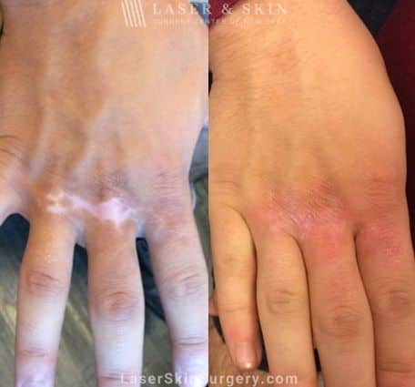 Laser Treatment for Hypopigmentation