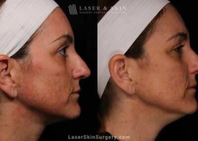 Laser Treatment for Melasma on the Face