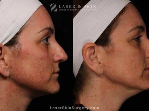 Laser Treatment for Melasma on the Face