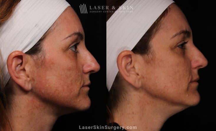 Facial Lasers for treating Melasma in NYC