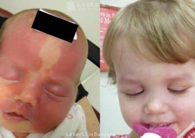 Laser Treatment for Port Wine Birthmark