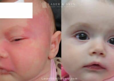 Laser Treatment for Port Wine Birthmark