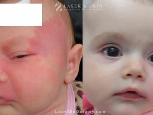 Laser Treatment for Port Wine Stain