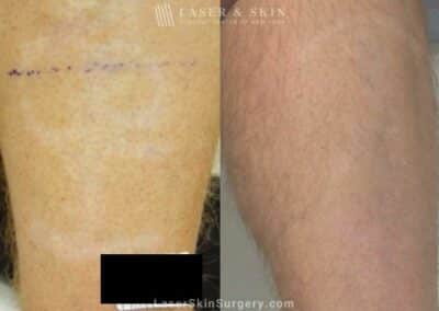 Fraxel Laser Treatment to minimize hypopigmentation