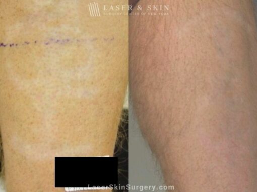 Fraxel Laser Treatment to minimize hypopigmentation