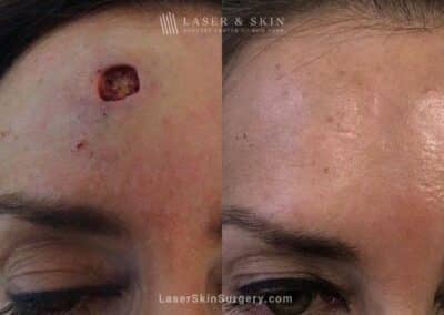 Mohs Micrographic Surgery to Treat Cancer on Forehead