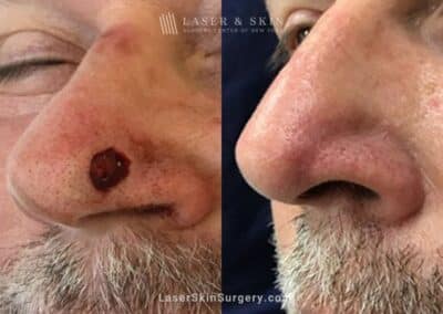 Mohs Micrographic Surgery for the Removal of Skin Cancer