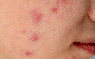 The Ultimate Guide to Treating Cystic Acne, featuring Dr. Anolik at HelloGiggles