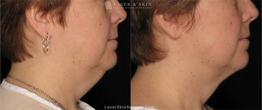 before and after of a standing liposuction in new york