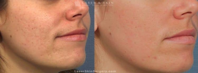 Before and After PicoSure Laser Treatment for Acne Scars