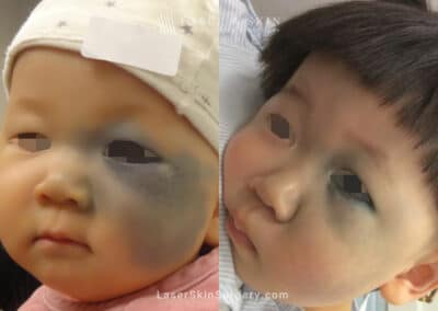 Laser Treatment for Nevus of Ota