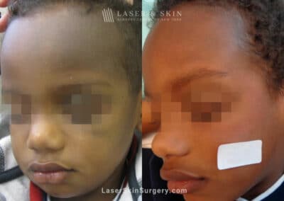 Laser Treatment for Nevus of Ota