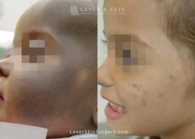 Laser Treatment for Nevus of Ota