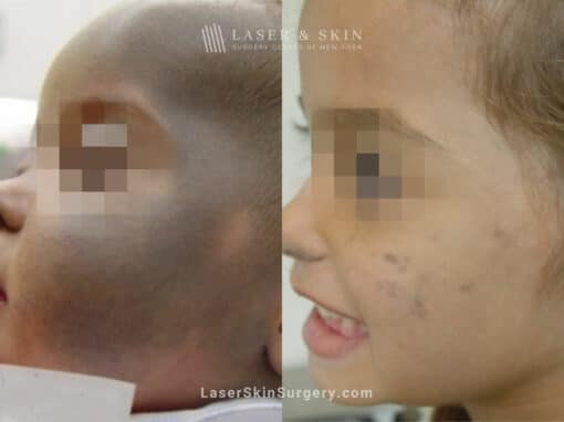 Laser Treatment for Nevus of Ota