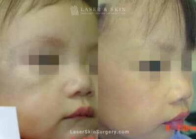 Laser Treatment for Nevus of Ota