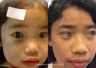 Laser Treatment for Nevus of Ota