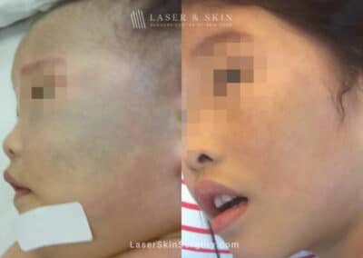 Laser Treatment for Nevus of Ota