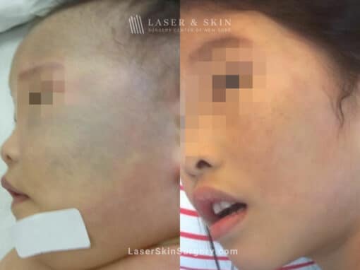 Laser Treatment for Nevus of Ota