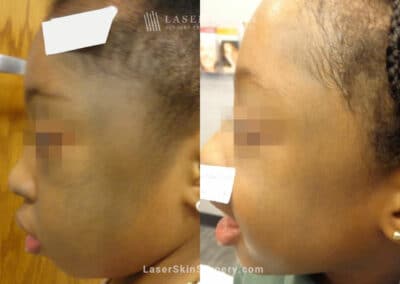 Laser Treatment for Nevus of Ota