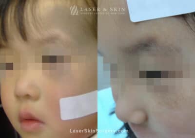 Laser Treatment for Nevus of Ota