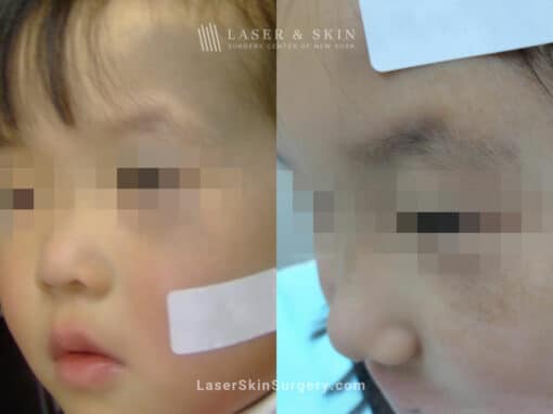 Laser Treatment for Nevus of Ota