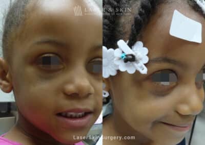 Laser Treatment for Nevus of Ota