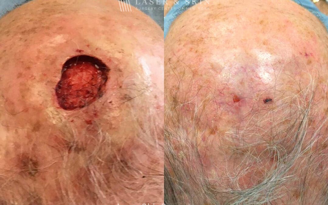 Mohs Surgery for Skin Cancer on the Scalp