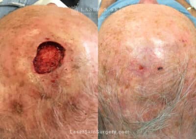 Mohs Surgery for Skin Cancer on the Scalp